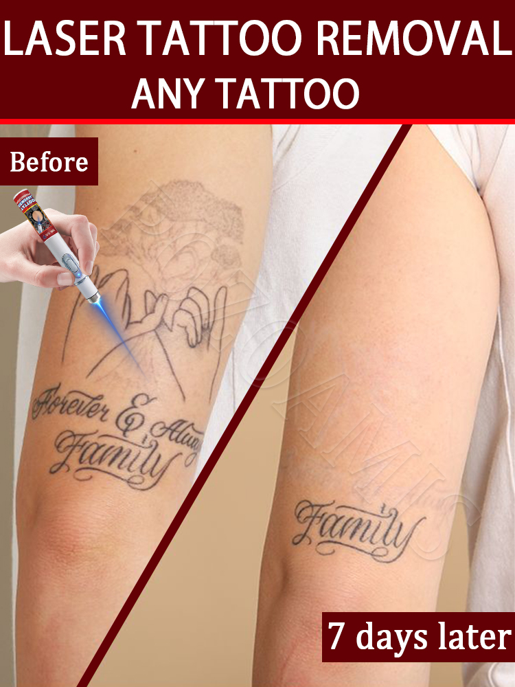 Nano laser tattooʀᴇᴍᴏᴠᴀʟ ᴘᴇɴ:  - Laser Toner Powder 리뷰 및 가격